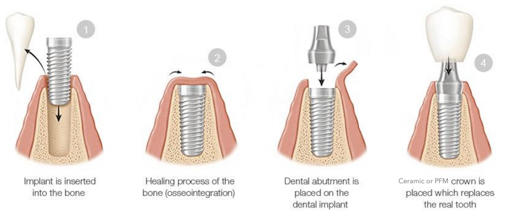 the typical dental implant treatment process normally takes 3-6 months and requires 4 steps