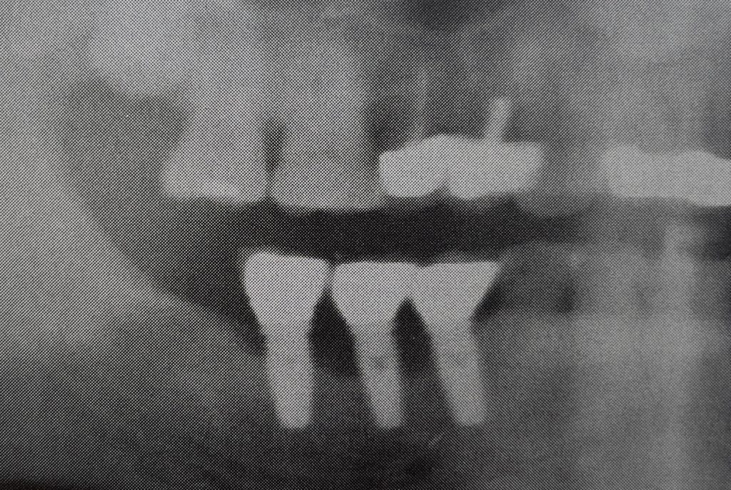 The x-ray shows loss of bone around the dental implants due to lack of proper home care and routine follow-up visits to the dentist for periodic cleaning and evaluation.