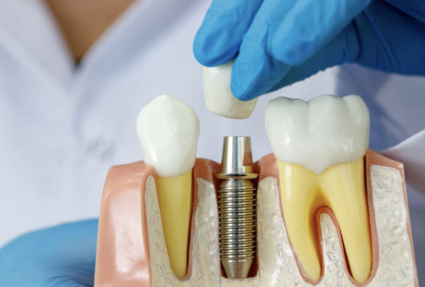 "A dental implant is an artificial tooth root that works like a natural one” The choice of materials for dental implants currently is Titanium which is biocompatible