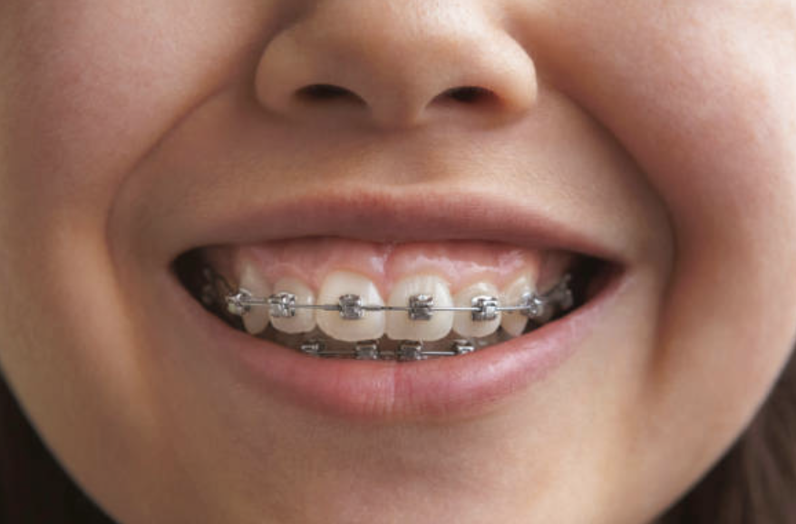 Orthodontics is defined as the art and science of straightening teeth. The Greek and Latin roots of ortho means "straight" and dontics refers to "teeth."