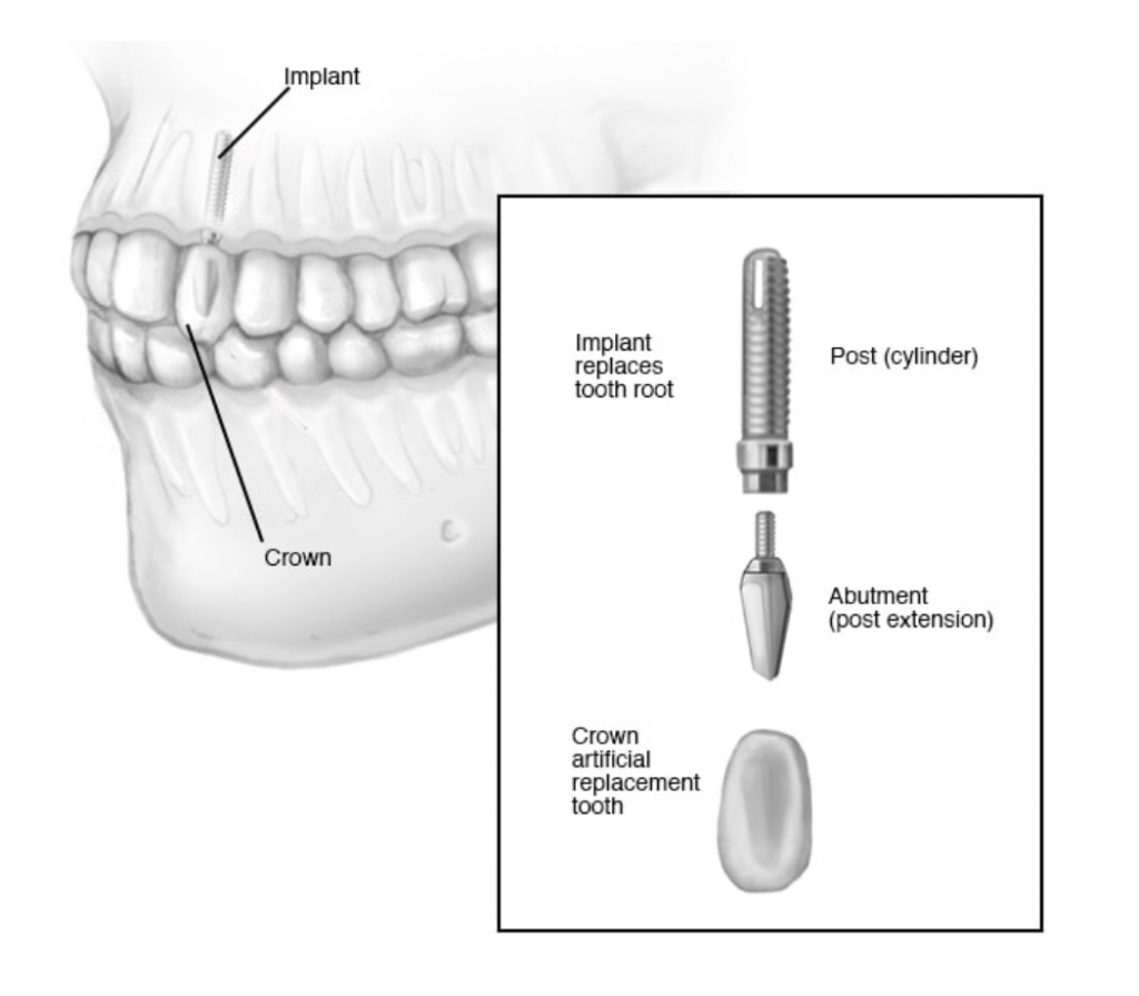 Pembedahan implan gigi
Implan gigi diperbuat daripada silinder besi yang menggantikan sebahagian akar untuk gigi yang hilang. Gigi tiruan (crown) diletak pada sambungan tiang (penyangga) di implan dan kelihatan seperti gigi sebenar.