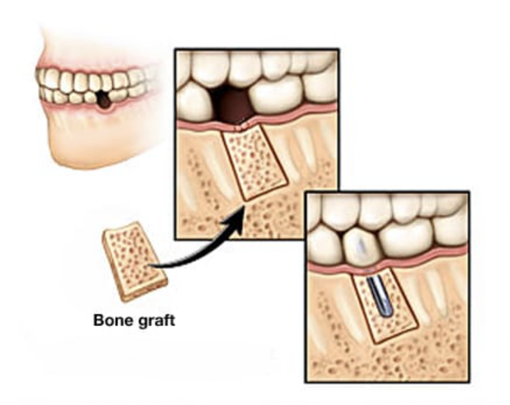 Doktor bedah mungkin perlu memindahkan sedikit tulang – biasanya dari tempat lain pada tulang rahang atas dan bawah – untuk memberikan implan gigi asas yang kukuh.