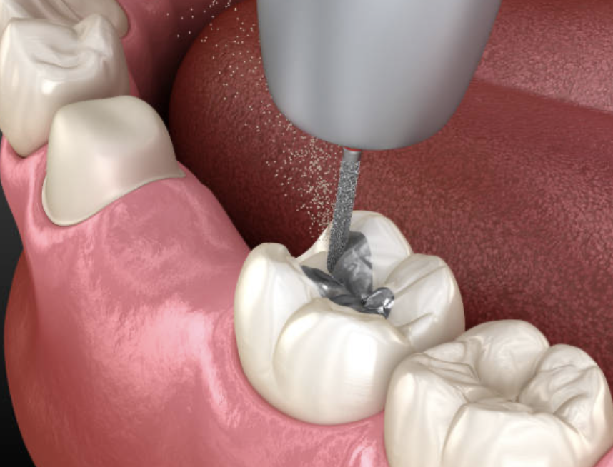 "without the benefit of amalgam restorations, many people today would be partially or completely without their teeth."