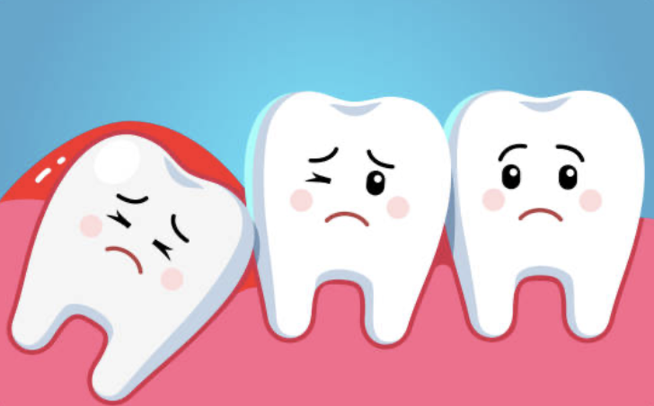 Gigi bungsu kadang-kadang boleh muncul arah yang berbeda-beda atau tersangkut dan hanya muncul sebahagiannya sebab kekurangan ruang. Gigi bungsu yang tumbuh seperti ini dikenali sebagai impaksi.