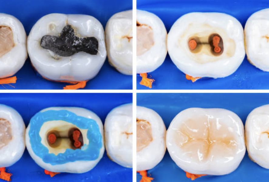 root canal treatment done on a previously amalgam filled tooth and filled with composite (tooth coloured dental material