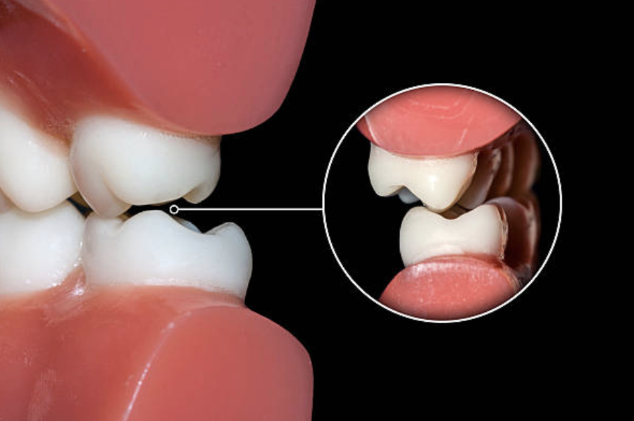 If all the factors are related in the manner that nature intended, the teeth will occlude (come together) correctly. If one or more of the factors is incorrect, malocclusion (incorrect bite) may be present, teeth may appear crooked and irregular, and the bite will be abnormal.