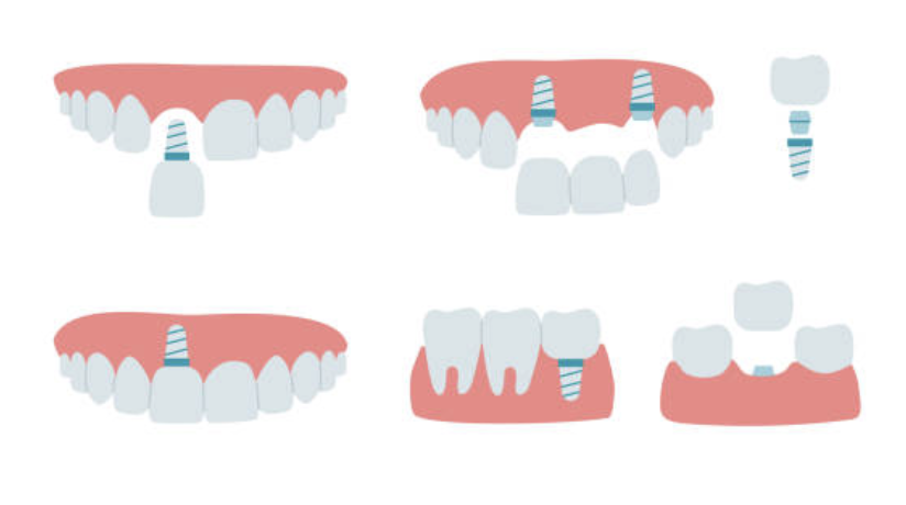 pelbagai kaedah implan gigi boleh digunakan untuk ganti gigi yang hilang