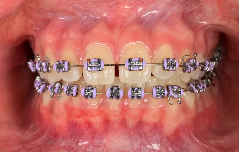 绑牙 . Conventional and Self-Ligating Braces . Pendakap Gigi . Ortho –  DENTIST3 – Dentist3